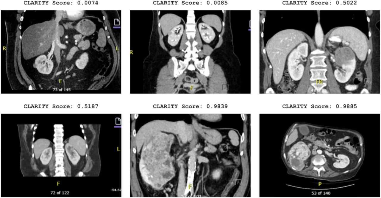 Representative preoperative CT images spanning a range of CLARITY scores, from low-complexity to high-complexity partial nephrectomy cases