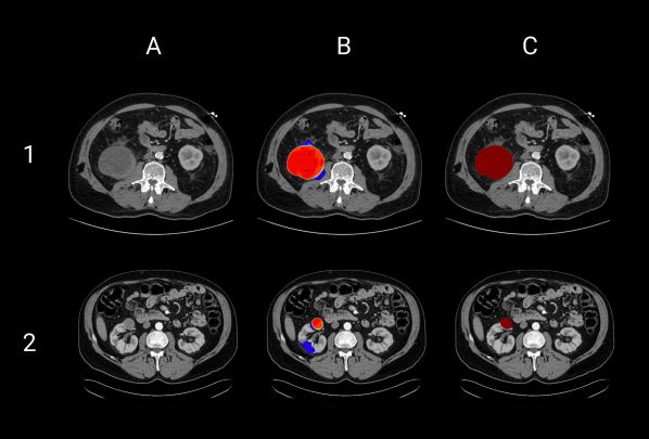 KiTS21 Challenge kidney tumor segmentation visualization showing AI algorithms for automatic kidney and tumor detection in CT scans