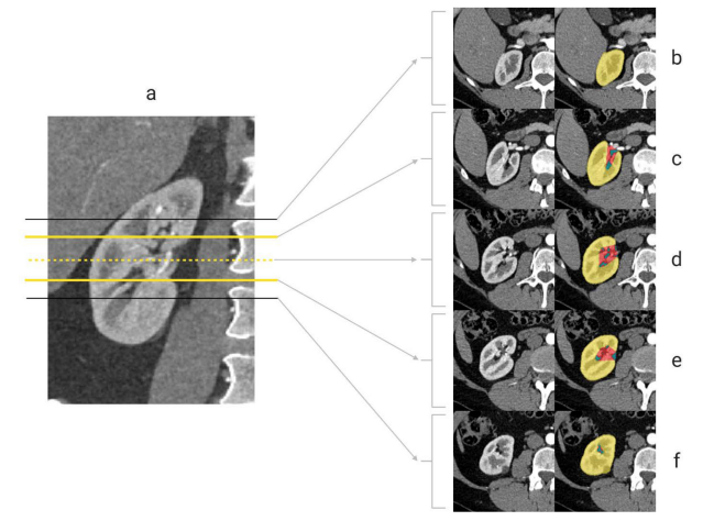 Computer Generated R.E.N.A.L. Nephrometry Score visualization showing AI-powered kidney tumor complexity assessment using deep learning